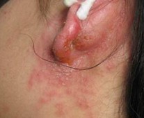 警惕!湿疹的饮食禁忌