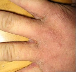 ½ê´¯ÖÎÁÆÒª×¢ÒâÄÄЩ