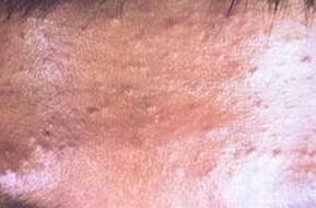 疥疮与传染之间的关系