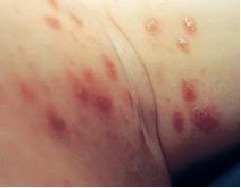 疥疮治疗时要注意什么