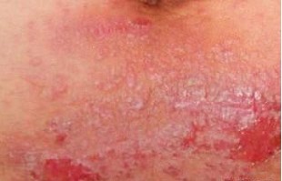 疥疮是一种什么病