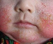 宝宝过敏性皮炎护理