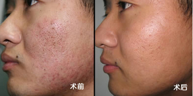 激光去雀斑要多少钱