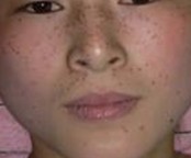 雀斑如何进行自我诊断