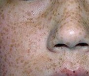 南昌皮肤科医院介绍雀斑的原因