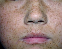 雀斑怎样去除效果最好