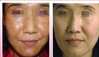 遗传性雀斑的症状表现