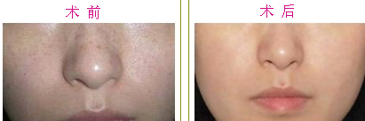 去雀斑,雀斑能去掉吗