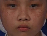 雀斑有哪些常见危害