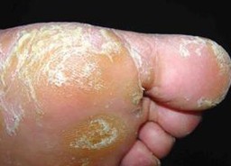 足癣患者存在的错误想法和观点