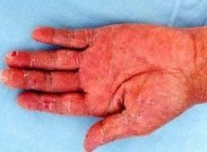 手痒、脱皮一定是手癣吗