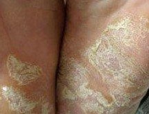 手足癣的发病缘由