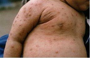 治疗疥疮的方法