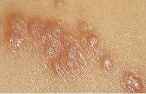 疥疮的治疗原则