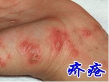不同疥疮的症状