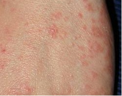 疥疮的治疗一定要彻底