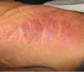 疥疮会有哪些表现症状