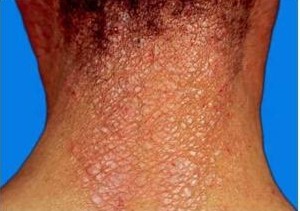 造成疥疮皮肤损害的原因有哪些