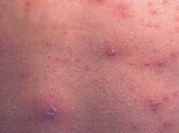 疥疮的直接感染途径介绍