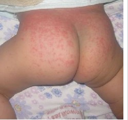 积极治疗疥疮控制病情