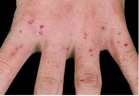 怎么快速治疗疥疮