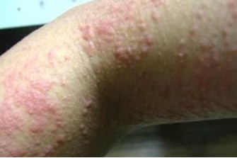 感染疥疮有哪些症状