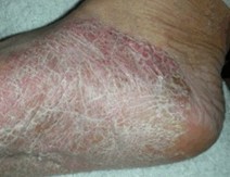 手足癣的危害体现在哪里