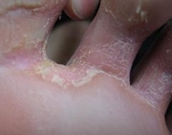 手足癣的预防措施