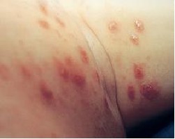 疥疮的初期症状