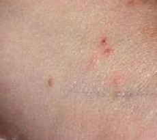 得了疥疮会传染给别人吗