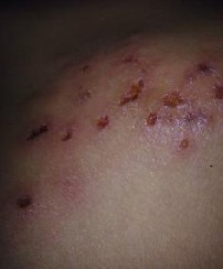 疥疮对皮肤的损害