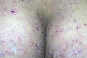 疥疮患者生活小细节