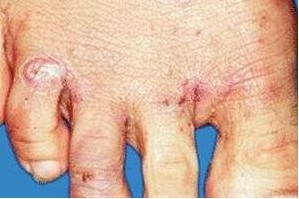 哪些部位容易发生疥疮结节