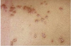 治疗疥疮的措施