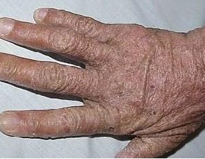 疥疮是由什么引起