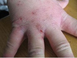 疥疮治疗期间要重视的事情