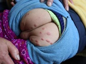 小孩感染疥疮怎么办