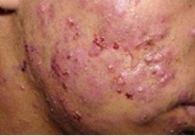 疥疮会不会传染到脸部