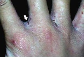 疥疮是通过什么传播的