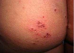 疥疮的五个发病特点