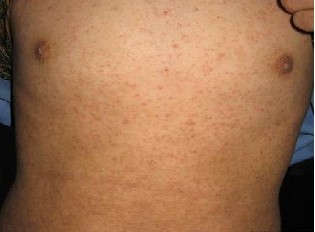 别拿疥疮当过敏湿疹