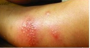 发生疥疮后的男女症状