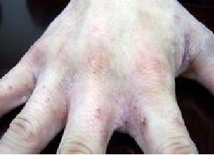 疥疮的传染性究竟怎么样