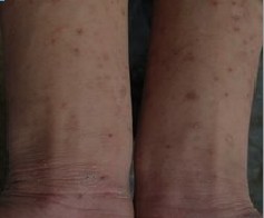 通过症状认识疥疮