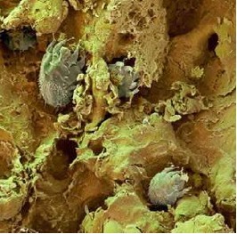 疥疮的传染性也是很强