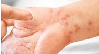 要预防疥疮的传染