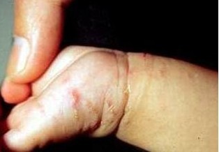 对疥疮的传染性介绍