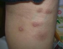 进行疥疮治疗时的禁忌