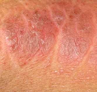 疥疮结节是否具有传染性