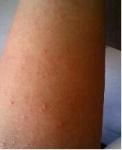 疥疮结节为何难治